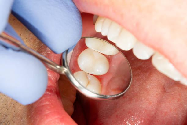 Image of a mouth and teeth being examined by a dentist